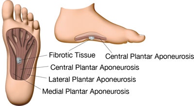 orthotics for plantar fibroma